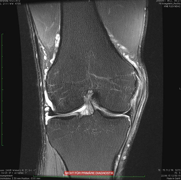 Frank Schleck x-ray